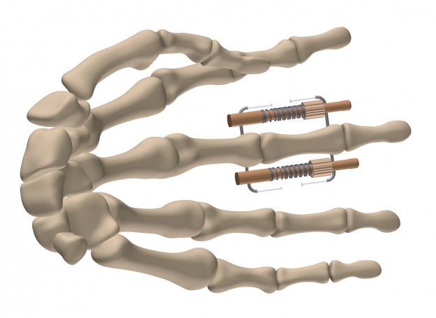 Gex-finger : تثبيت خارجي للأصابع