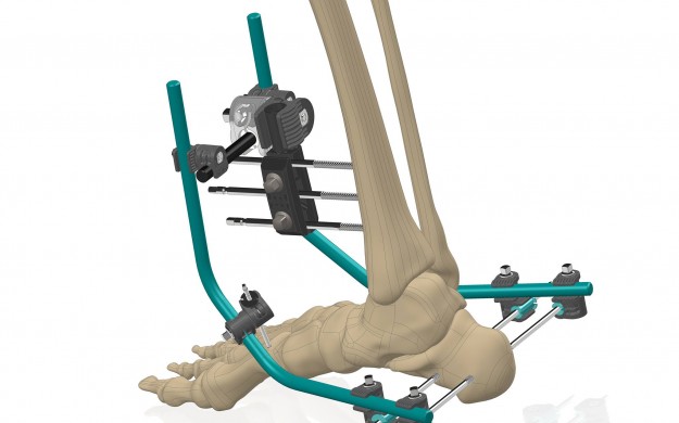 Lancement officiel du Gexfoot, fixateur externe du pied Lancement officiel du Gexfoot, fixateur externe du pied