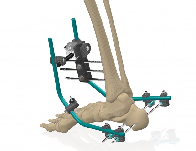 Lancement officiel du Gexfoot, fixateur externe du pied Lancement officiel du Gexfoot, fixateur externe du pied