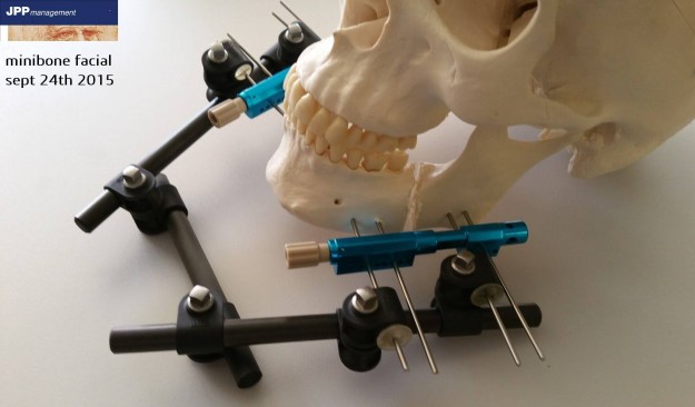 Minibone facial pour reconstruction faciale Minibone facial pour reconstruction faciale