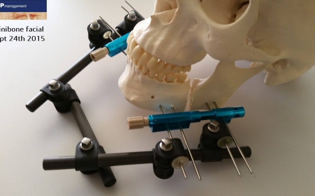 Minibone facial pour reconstruction faciale Minibone facial pour reconstruction faciale